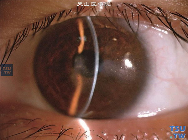 同一患者，裂隙灯显微镜检查，眼角膜瘢痕深达基质层，眼角膜变薄