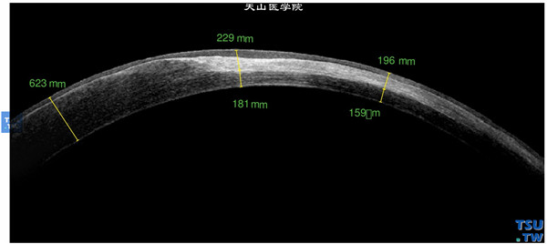 同一患者，RTvue OCT 检查，显示眼角膜基质瘢痕，瘢痕区眼角膜影像密度增高，厚度变薄