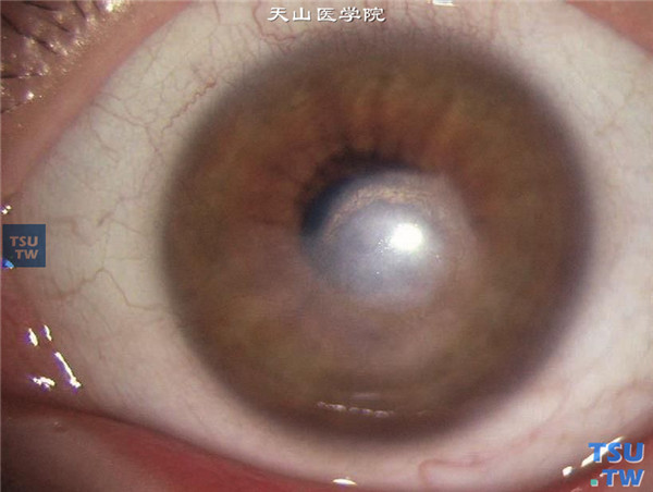 眼角膜白斑，瘢痕致密，边界清楚，眼角膜无水肿和炎症