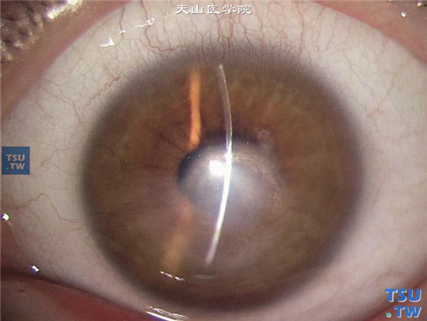 同一患者，裂隙灯显微镜检查，显示眼角膜全层混浊，眼角膜变薄，无水肿和炎症表现