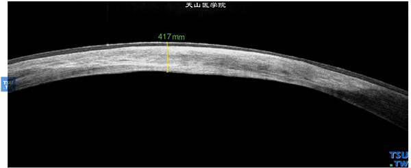同一患者，RTvue OCT检查，显示眼角膜致密的瘢痕波及眼角膜内皮层，厚度较正常眼角膜变薄，上皮完整，眼角膜无炎性水肿