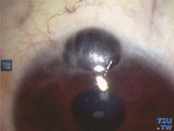 眼角膜葡萄肿，显示12点位眼角膜缘局限性葡萄肿，眼角膜变薄，虹膜与眼角膜粘连前突