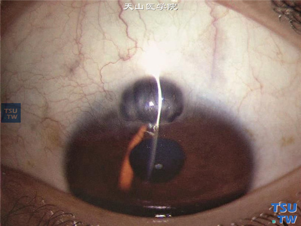 同一患者，裂隙灯显微镜检查，显示眼角膜葡萄肿位置，眼角膜薄如纸，仅有后弹力层和上皮层