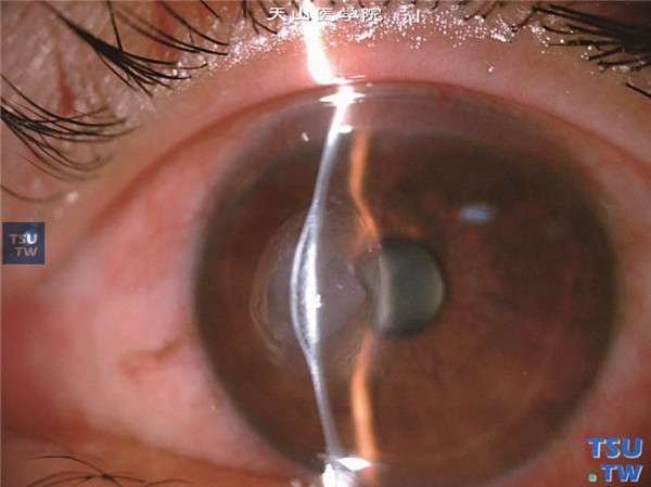 眼角膜基质内上皮植入性囊肿