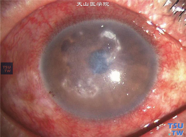 症状：表皮葡萄球菌感染，角膜感染灶为多发局限性脓疡，伴有灰白色角膜基质浸润
