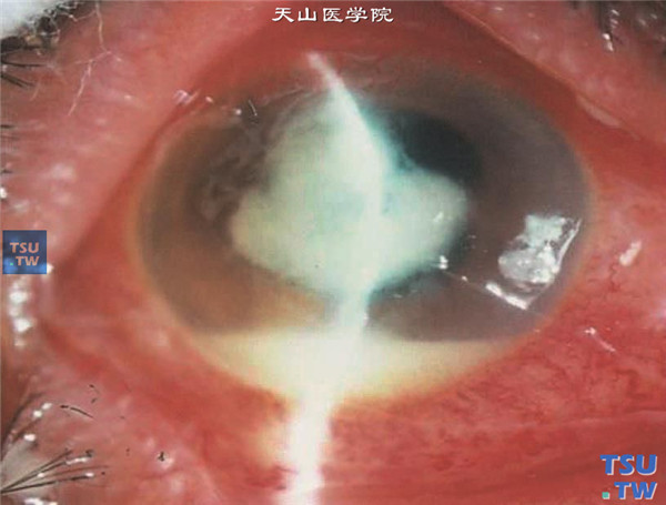上述两张图片为金黄色葡萄球菌角膜炎，混合充血，病情险恶，感染早期可见角膜深基质的浸润，感染灶的边界欠清，伴有前房积脓