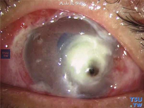 上述两张图片为金黄色葡萄球菌性角膜炎，病情发展迅速，角膜组织大范围自溶坏死，角膜大穿孔和虹膜脱出