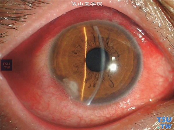 症状：金黄色葡萄球菌角膜周边部溃疡，表现为角膜边缘反复发作的椭圆形溃疡浸润，伴有新生血管长入