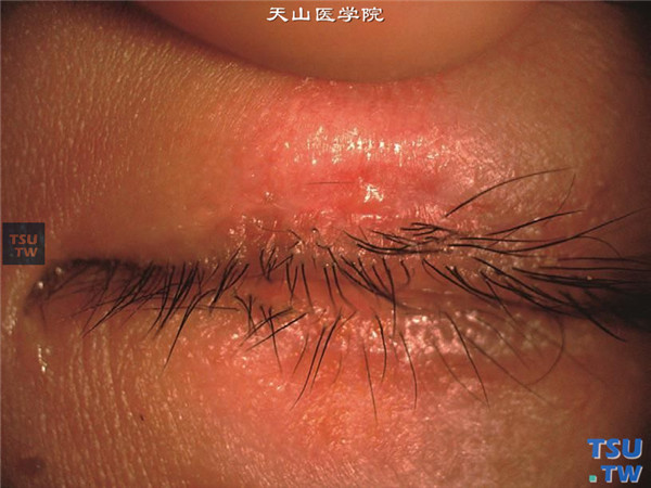 症状：金黄色葡萄球菌睑缘炎，上下睑缘和睫毛根部有溃疡和脓性分泌物附着，眼睑皮肤有湿疹样改变