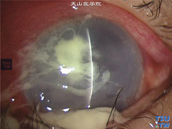 症状：铜绿假单胞菌角膜炎
