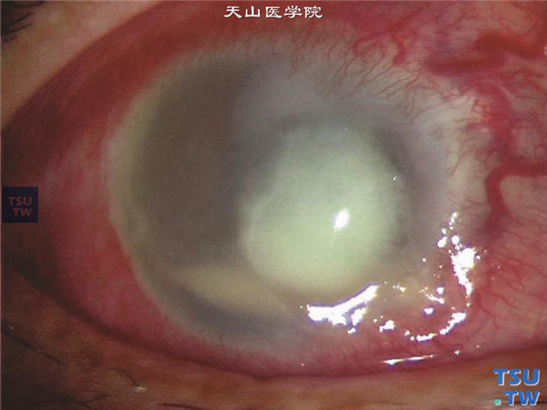症状：铜绿假单胞菌角膜炎