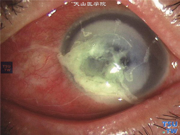 上述四张图片均为铜绿假单胞菌角膜炎，病情进展迅猛，混合充血，角膜基质溶解坏死，溃疡表面为淡黄绿色黏胶状分泌物，伴有前房积脓