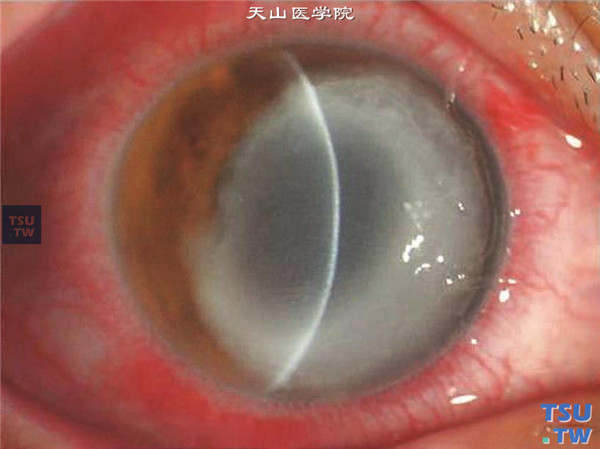 上述两张图片显示LASIK术后双眼细菌感染，无典型细菌性角膜炎的临床特征，但有明确手术史，角膜水肿，炎性浸润和坏死，细菌培养结果为肺炎克雷伯菌