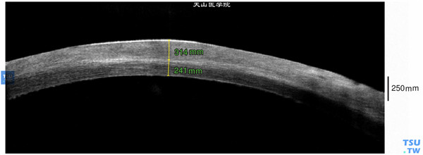 左眼RTvue OCT检查，可见角膜基质炎性水肿，混浊，厚薄不均，图像上皮层缺失，内皮面水肿粗糙，失去均匀、光滑和连续性