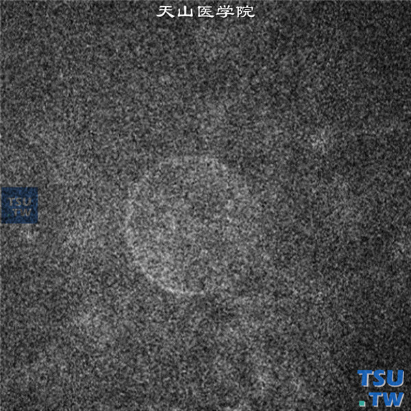 同一患者，临床共聚焦显微镜检查，内皮细胞层无法成像 ×800