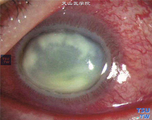 严重细菌性角膜炎，当感染得不到控制，除了整个角膜化脓坏死外，炎症可向眼内发展，导致眼内炎