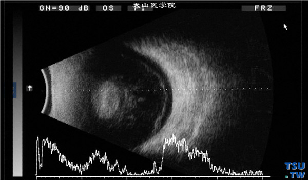 同一患者，B型超声检查，可见玻璃体明显混浊，提示眼内炎症，临床上对眼前部严重感染的病例，应常规做B型超声检查