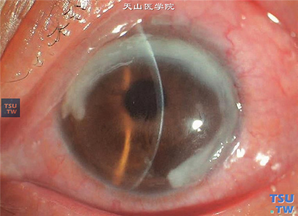 症状：LASIK术后发生角膜周边部溃疡，为金黄色葡萄球菌感染，角膜周边部基质环形炎性浸润，混合充血