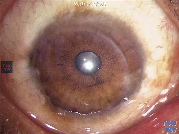 上述病例，行板层角膜移植术，术后随访2年9个月，角膜植片透明，裸眼视力0.4
