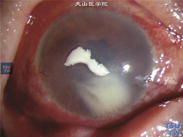 症状：真菌性角膜炎菌丝苔被