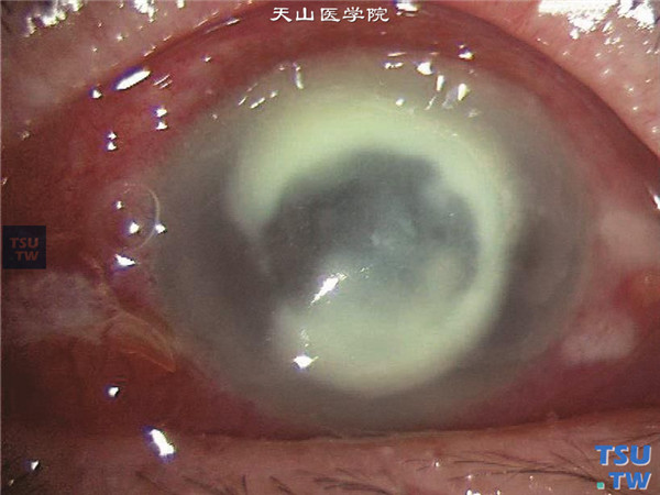 症状：真菌性角膜炎免疫环