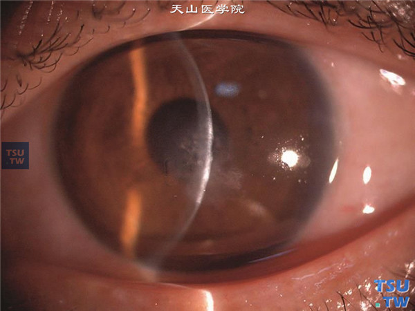 症状：真菌性角膜炎内皮斑