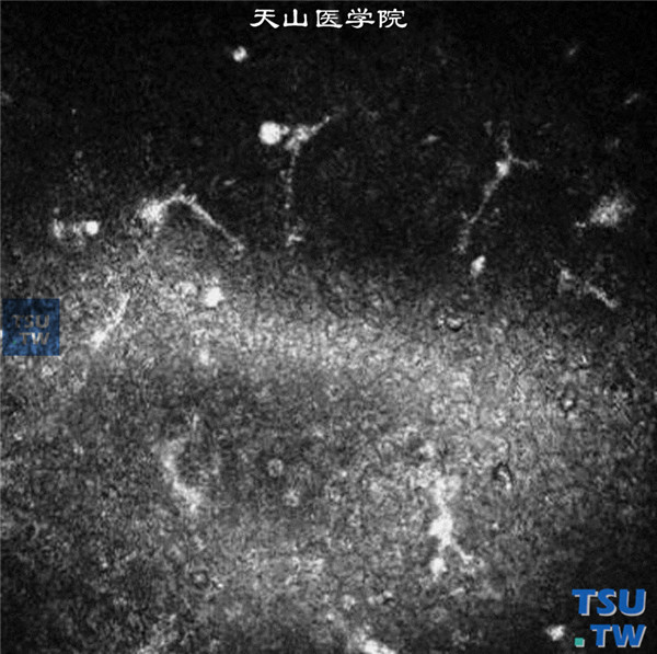 真菌性角膜炎内皮斑患者，行临床共聚焦显微镜检查，可见角膜内皮面有多量斑点状、条索状、带有伪足样等结构不规则形状的斑块，这对术前手术方式的选择是至关重要的 ×80