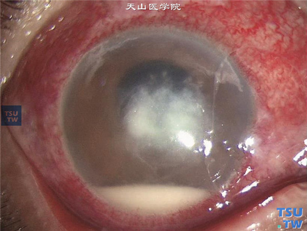症状：真菌性角膜炎前房积脓