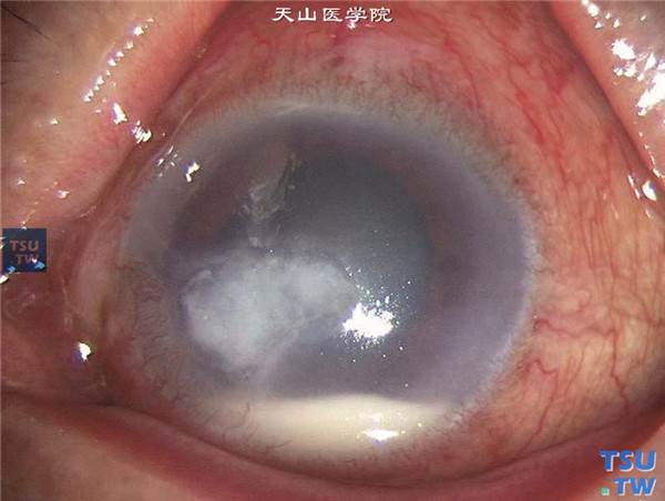 症状：真菌性角膜炎前房积脓
