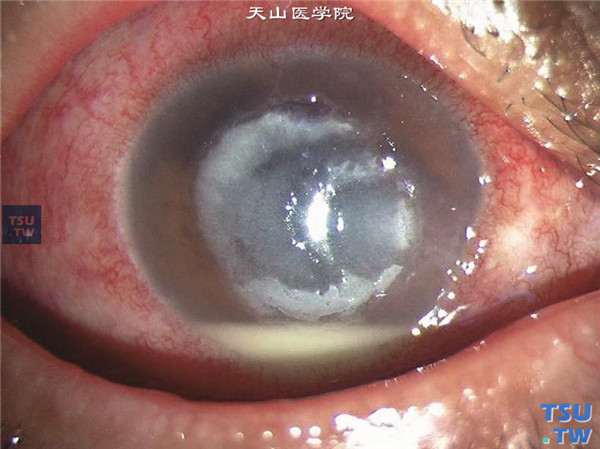 症状：真菌性角膜炎前房积脓