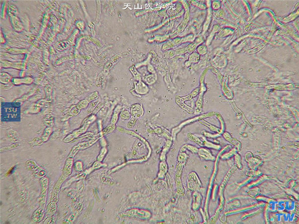 手术显微镜下刮取病变明显处角膜组织，标本行10%氢氧化钾湿片法，显微镜下观察到真菌菌丝和（或）孢子，可以确诊为真菌性角膜炎 ×400