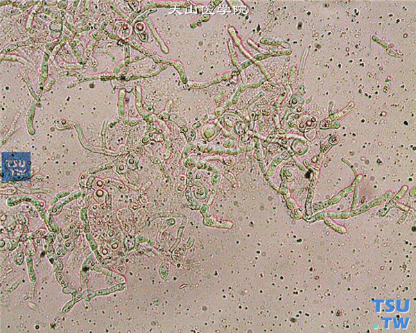 10%氢氧化钾湿片法，显微镜下观察到真菌菌丝和（或）孢子，方法简便、快速，在临床上极易推广应用 ×400