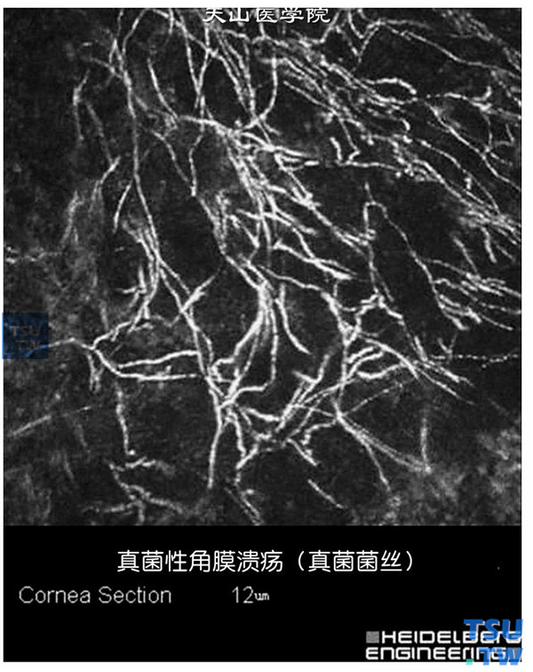 对早期角膜炎患者，行临床共聚焦显微镜检查，在角膜浅基质层，发现大量真菌菌丝，可确诊为真菌性角膜炎 ×800