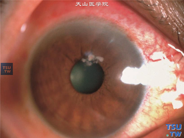  右眼反复红、痛视力下降10个月，否认外伤史，局部曾使用抗生素、抗病毒药物和糖皮质激素治疗，病情反复，就诊时视力0.8