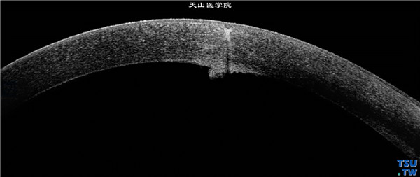 . RTvue OCT检查，显示角膜病变区有穿通伤痕迹，与角膜后沉着物相连，患者为果农，10个月前，在果园内劳作时，曾有眼部不适