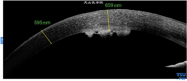 RTvue OCT检查，显示角膜内皮层病变区有内皮斑样物，角膜基质有轻度炎性水肿，上皮层完整