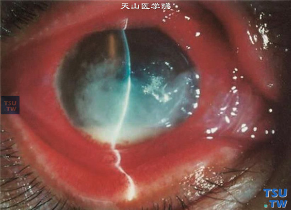 症状：真菌性角膜炎术前，病变累及角膜全层，但溃疡范围广泛偏中心