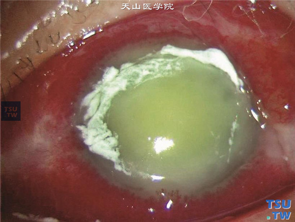 症状：上述两张图片显示严重真菌性角膜炎，当感染得不到控制，除了整个角膜化脓坏死外，炎症可向眼内发展，导致眼内炎