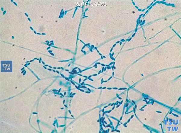 症状：同一患者，角膜病灶刮片标本培养，结果为串珠镰刀菌，乳酸酚棉蓝染色在显微镜（×400）下观察的图像