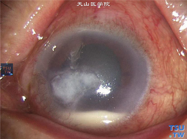 症状：真菌性角膜炎