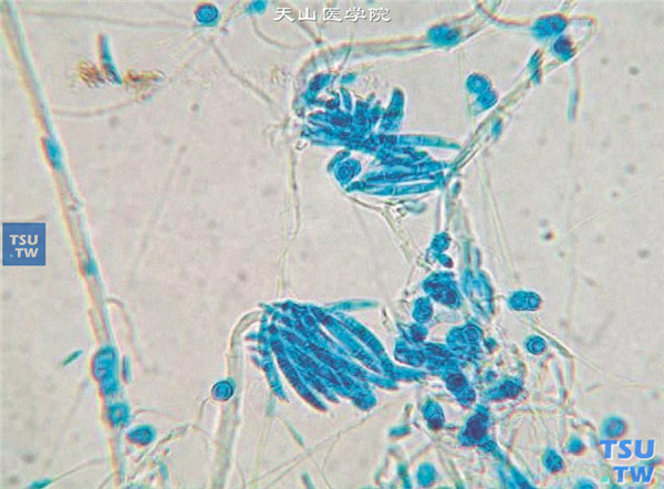 同一患者，角膜病灶刮片标本培养，结果为茄病镰刀菌，乳酸酚棉蓝染色在显微镜（×400）下观察的图像，孢子为镰刀状