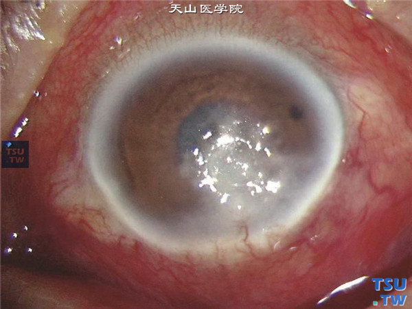 症状：真菌性角膜炎