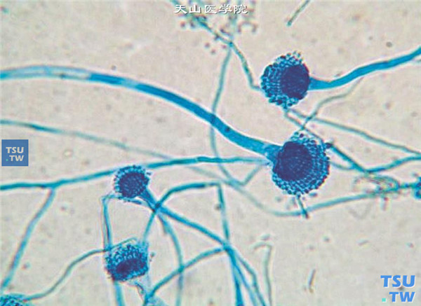 同一患者，角膜病灶刮片标本培养，结果为烟曲霉菌，乳酸酚棉蓝染色在显微镜（×400）下观察的图像