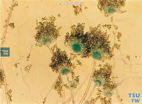 同一患者，角膜病灶刮片标本培养，结果为黄曲霉菌，乳酸酚棉蓝染色在显微镜（×400）下观察的图像  曲霉菌属在真菌性角膜炎的病原学检查中占第二位。