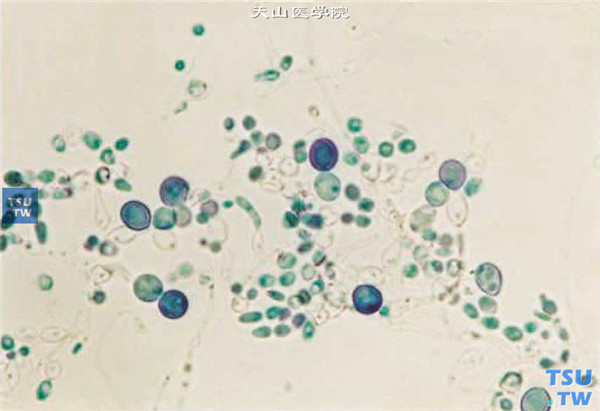 同一患者，角膜病灶刮片标本培养，结果为白色念珠菌，乳酸酚棉蓝染色在显微镜（×400）下观察的图像