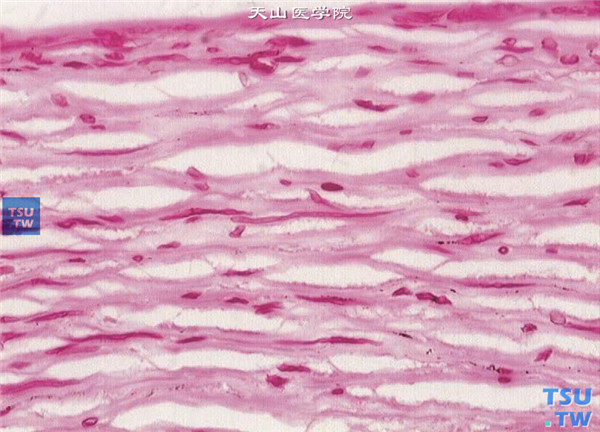  上述两张图片显示真菌性角膜炎患者，术中获取病变角膜片，行组织病理学检查，PAS染色显示茄病镰刀菌菌丝在角膜基质内主要呈水平生长