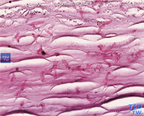 上述两张图片显示真菌性角膜炎患者，术中获取病变角膜片，行组织病理检查，PAS染色可见烟曲霉菌菌丝在角膜基质内垂直生长 PAS×400