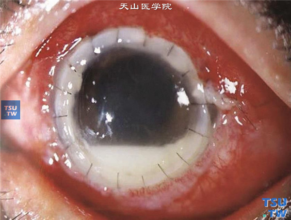 上述四张图片显示真菌性角膜炎行穿透角膜移植术后，真菌复发，复发来自于前房、房角或相邻组织