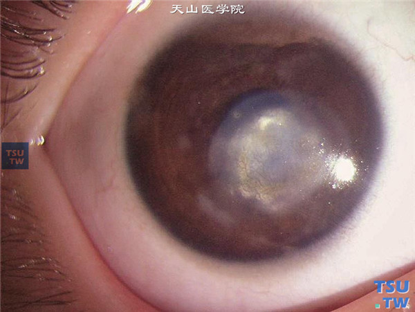 症状：单纯疱疹病毒性角膜炎稳定期，结膜无充血，角膜瘢痕边界清楚，角膜基质内有深层新生血管长入，基质内有类脂质样物沉着