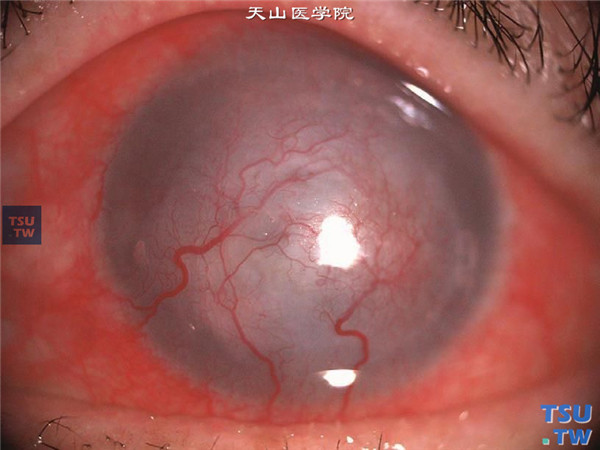 症状：单纯疱疹病毒性角膜炎晚变期，角膜基质内有明显活动性病变，混合充血，大量新生血管长入角膜基质内，并充血扩张，全角膜水肿、混浊，仅角膜缘处角膜可见虹膜